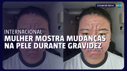 Mulher viraliza ao mostrar mudanças no rosto durante gravidez