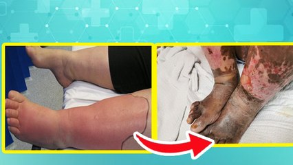 Cellulitis Kya Hai: पैरों में सेल्युलाइटिस क्यों होता है, Symptoms, Causes, Treatment...