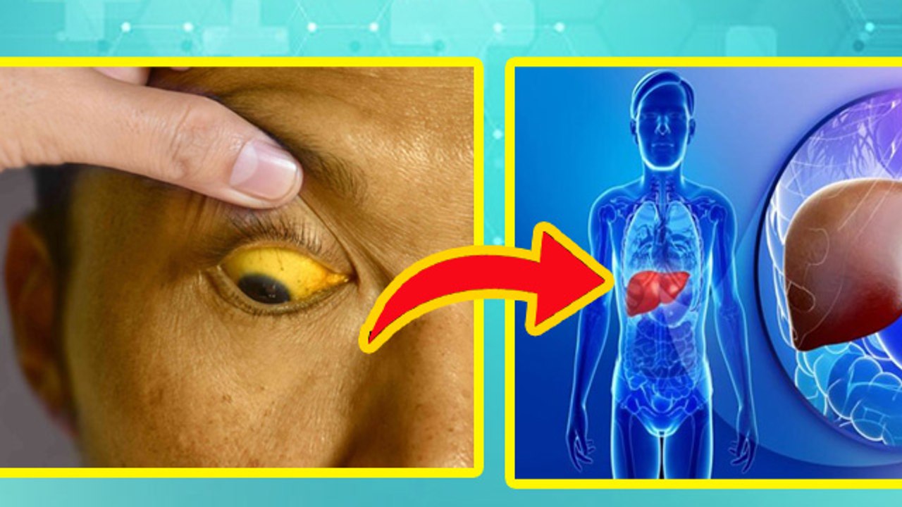 पीलिया कब होता है जानलेवा खतरनाक,Piliya Kab Khatarnak Hota Hai|Jaundice Symptoms | Boldsky