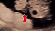 20wks Pregnancy Ultrasound - Gastroschisis | a defect in baby's abdominal wall  #pregnancy