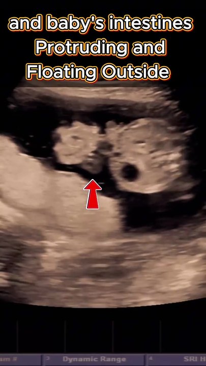20wks Pregnancy Ultrasound - Gastroschisis | a defect in baby's abdominal wall  #pregnancy