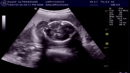 Gross Fetal Hydrops - at 22wks Pregnancy | Diagnostic Criteria | Prognosis | Causes