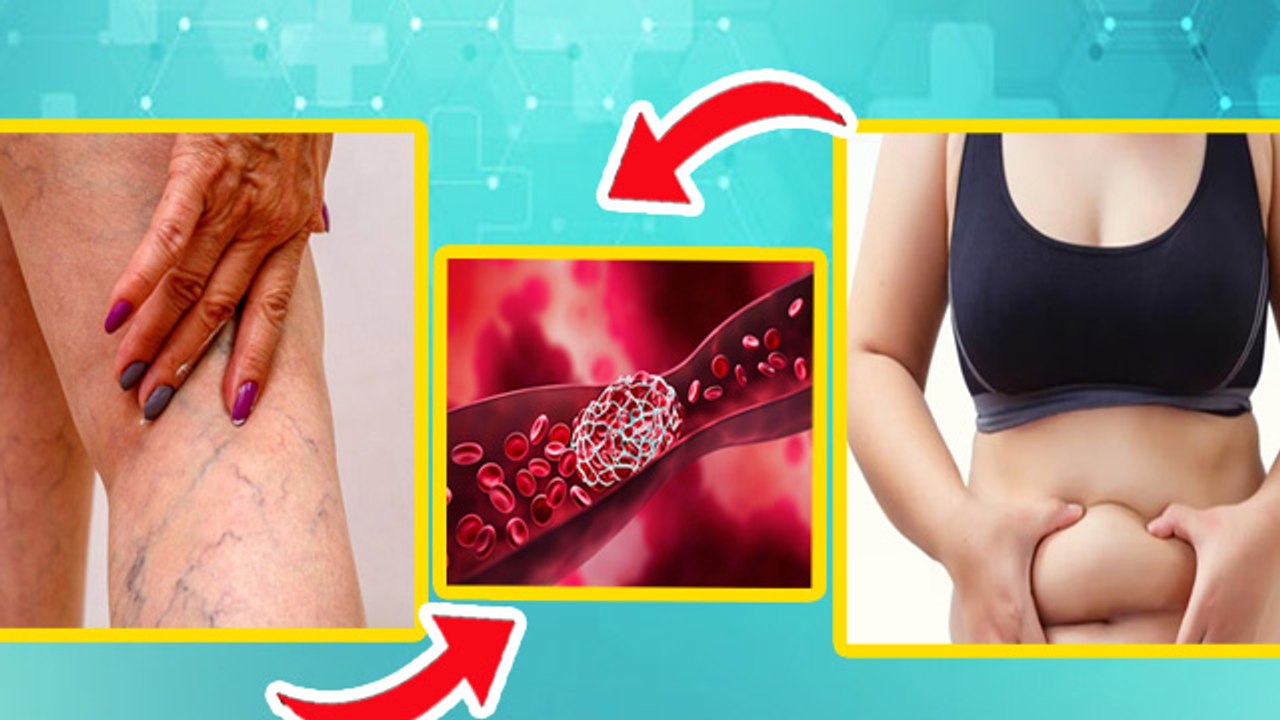 Blood Clotting In Legs: Pair Me Blood Clot Kyu Hota Hai,खून के थक्के जमने के क्या लक्षण हैं |Boldsky