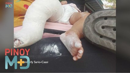 Paano ginagamot ang kondisyong clubfoot? | Pinoy MD
