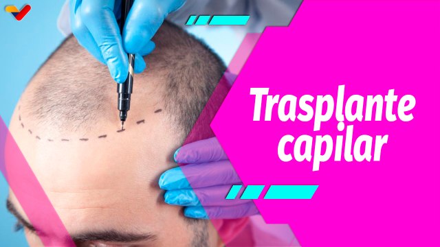 Buena Vibra | Trasplante capilar: ¿En qué consiste y cuáles son sus resultados?