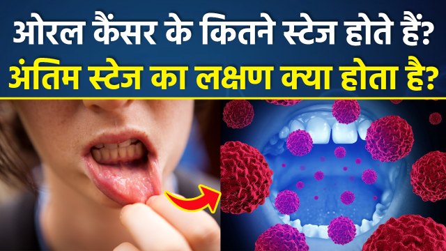 Oral Cancer Causes:मुंह के कैंसर के लक्षण क्या हैं, Symptoms Of Mouth Cancer |Stages Of Oral Cancer
