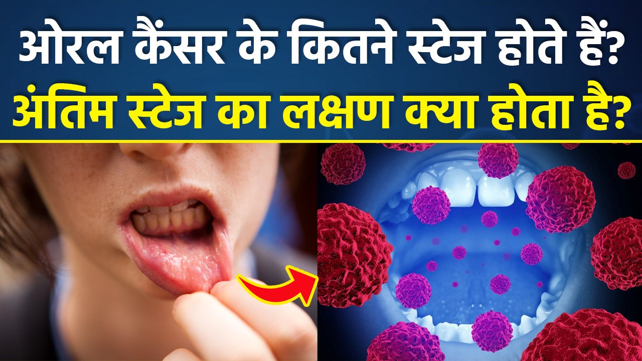 Oral Cancer Causes:मुंह के कैंसर के लक्षण क्या हैं, Symptoms Of Mouth Cancer |Stages Of Oral Cancer