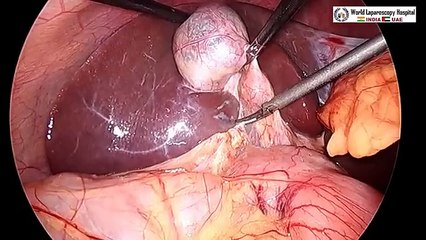 Safe Way of Performing Laparoscopic Cholecystectomy