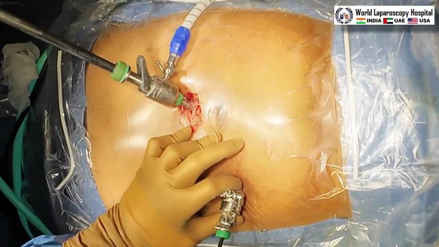 Laparoscopic Repair of Bilateral Inguinal Hernia with Ipsilateral Port: A Comprehensive Approach