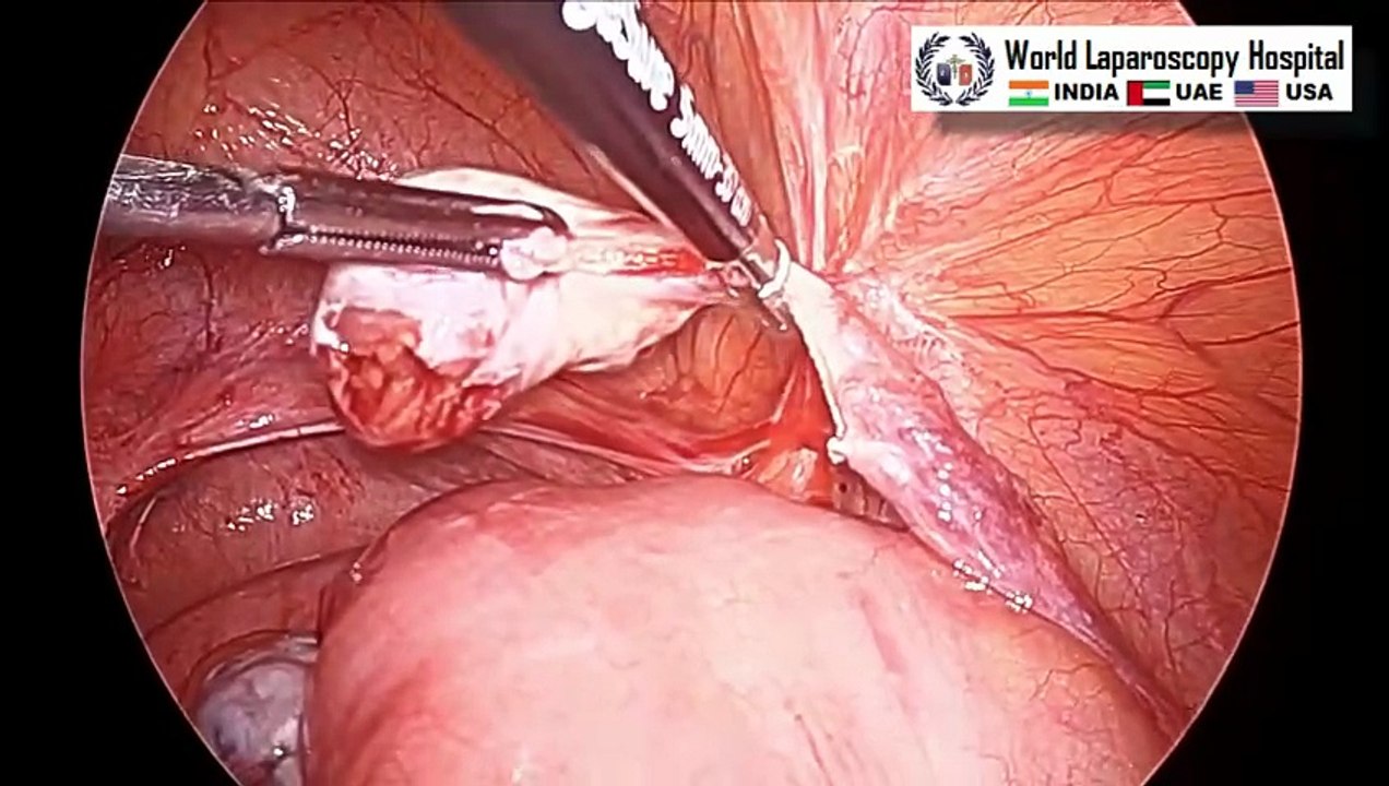 Laparoscopic Oophorectomy in Patients with Estrogen Receptor-Positive Breast Cancer