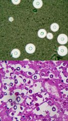 Tratamiento Efectivo para Micosis Avanzada