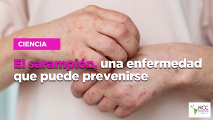 El sarampión, una enfermedad que puede prevenirse
