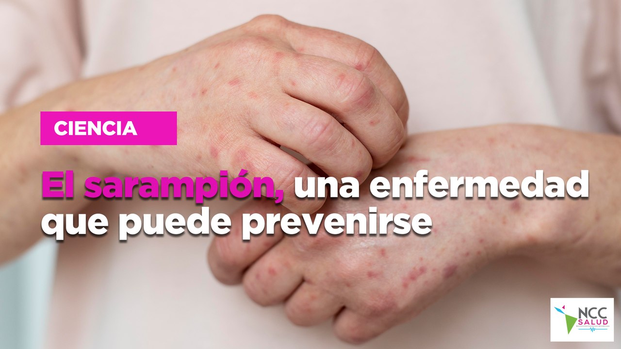 El sarampión, una enfermedad que puede prevenirse