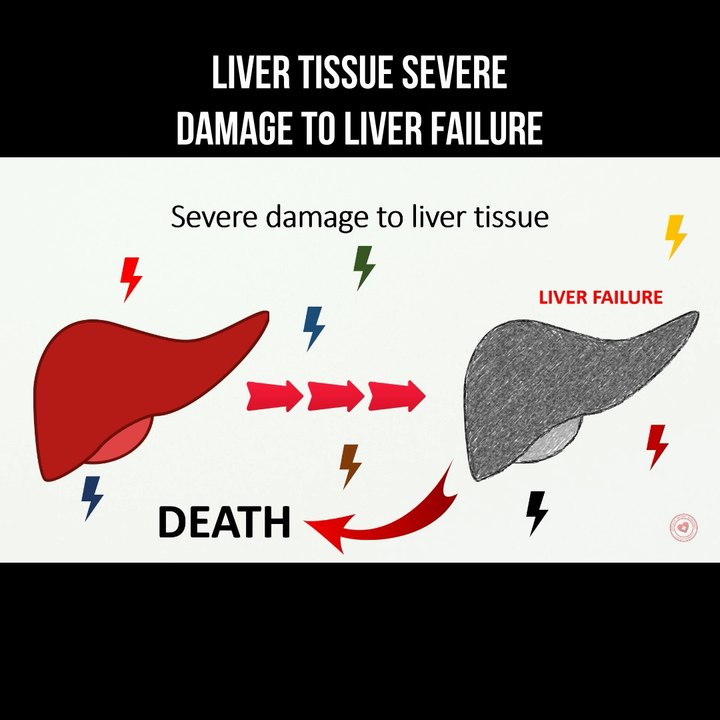 Liver tissue severe damage to liver failure