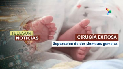 En Argentina, el Hospital Garrahan llevó a cabo la separación exitosa de dos siamesas gemelas