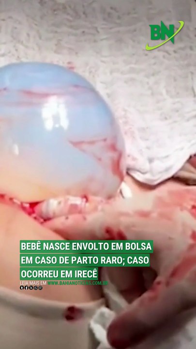 VÍDEO: Bebê nasce envolto em bolsa em caso de parto raro; caso ocorreu em Irecê