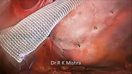 Laparoscopic Repair of Incisional Hernia by Dr. R.K. Mishra