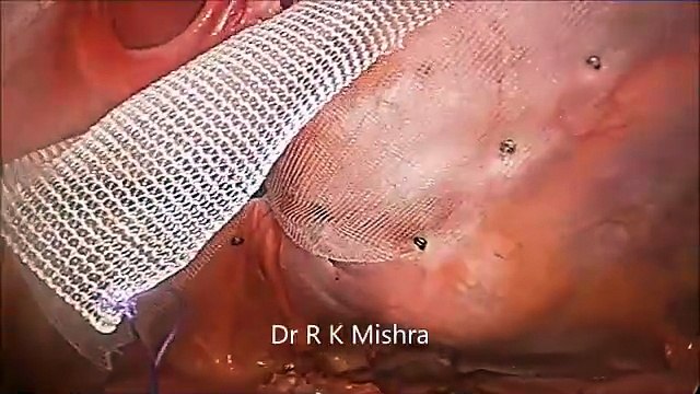Laparoscopic Repair of Incisional Hernia by Dr. R.K. Mishra