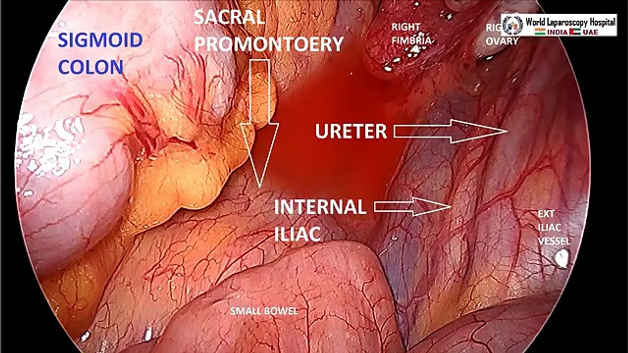 Diagnostic Laparoscopy, Hysteroscopy and Dye Test for Infertility