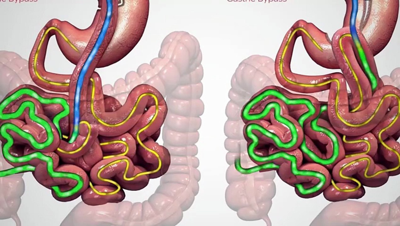 One Anastomosis Gastric Bypass (OAGB)