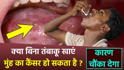 Oral Cancer Causes: बिना तंबाकू खाएं मुंह का कैंसर हो सकता है. Muh Ka Cancer Kyu Hota Hai...