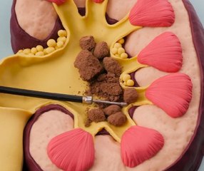 How Kidney Stones Are Treated