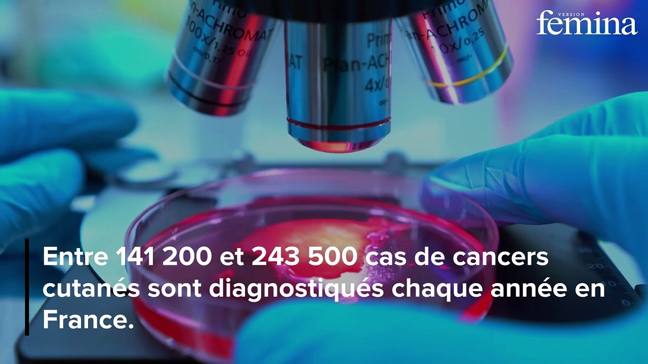 Cancers de la peau : 7 zones surprenantes à surveiller de près selon un expert
