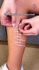 How to Close Wounds Fast Without Medical Tools