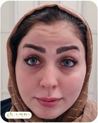 تزریق بوتاکس و قبل و بعد آن در کلینیک نوین ایرانا