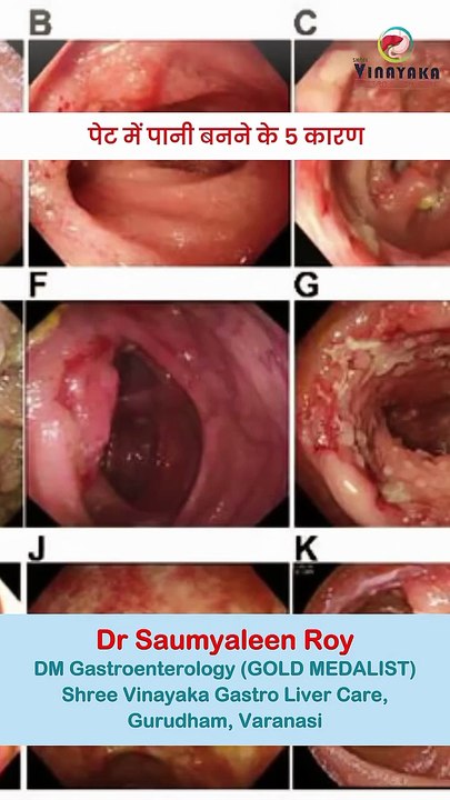 Ascites क्या है? पेट में पानी भरने की गंभीर वजहें