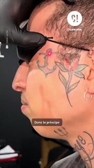 Comment marche le détatouage laser ?