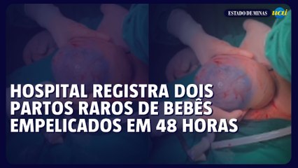 Hospital registra dois partos raros de bebês empelicados em 48 horas
