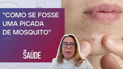 Dermatologista revela sintomas e alertas da celulite facial | JP SAÚDE