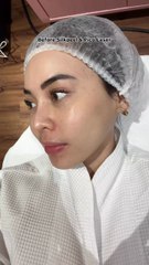 Monthly treatment aku? Silkpeel Pico Laser