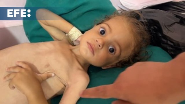 Médicos alertan del aumento de casos graves de desnutrición infantil en Gaza