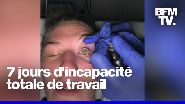 Victimes de brûlures aux yeux, dix jeunes hospitalisés après une soirée mousse dans un bar d'Argelès-sur-Mer