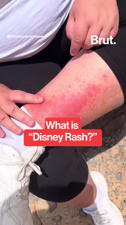 What is Disney Rash?