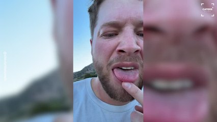 Man's Tongue Swells After Bee Sting on Run