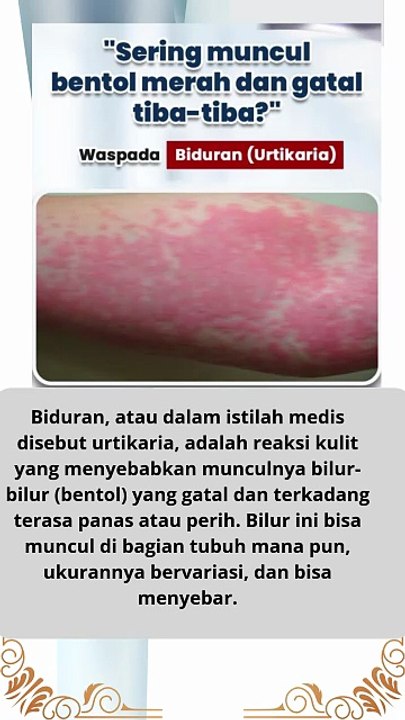 apa itu penyakit biduran dan fakta yang harus kita ketahui
