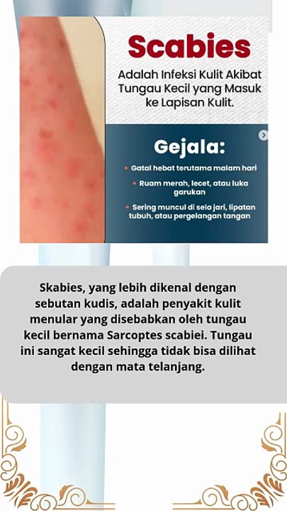Apa itu penyakit Scabies itu  #news