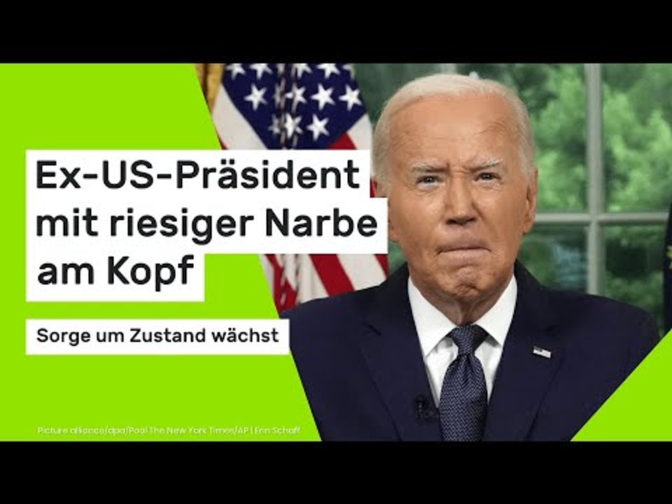 Ex-US-Präsident mit riesiger Narbe am Kopf - Sorge um Zustand wächst