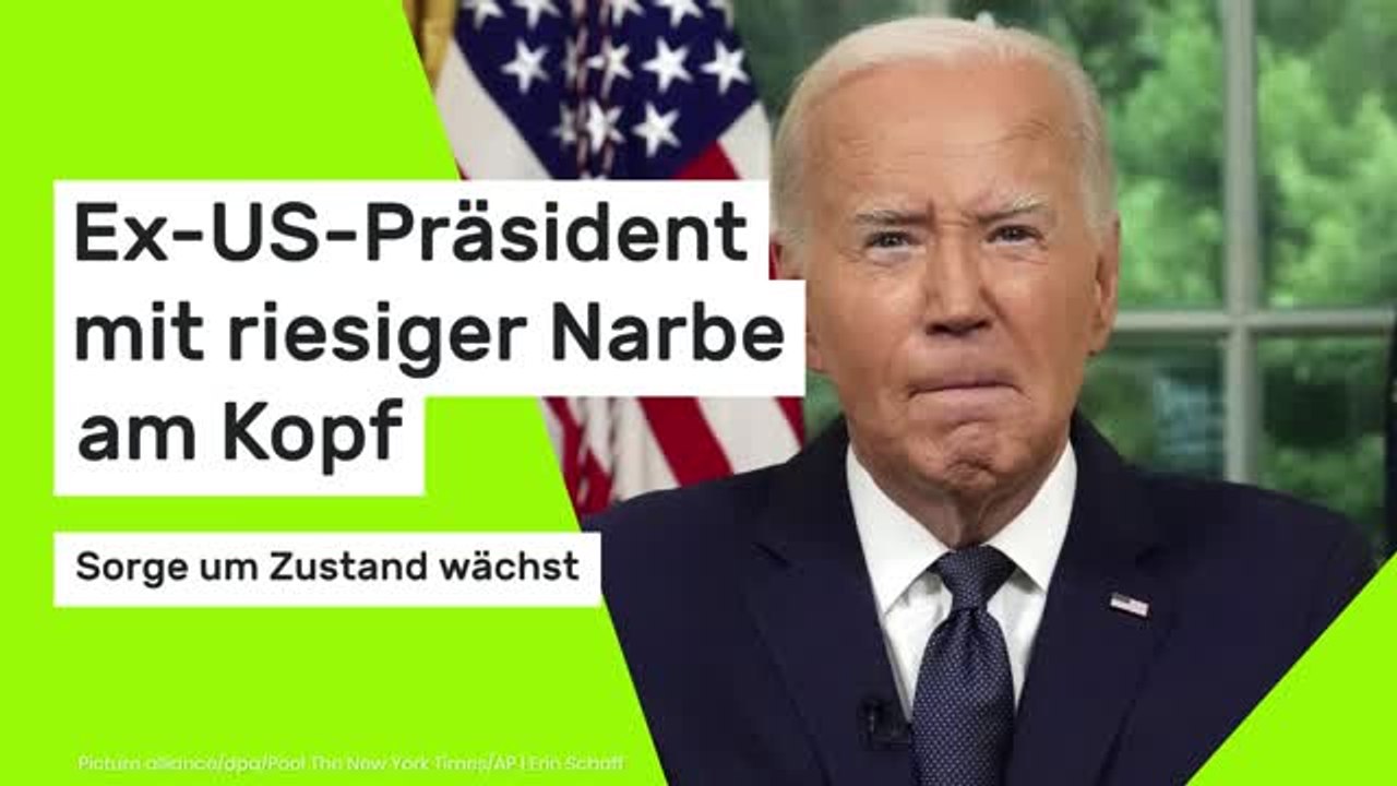 Ex-US-Präsident mit riesiger Narbe am Kopf - Sorge um Zustand wächst