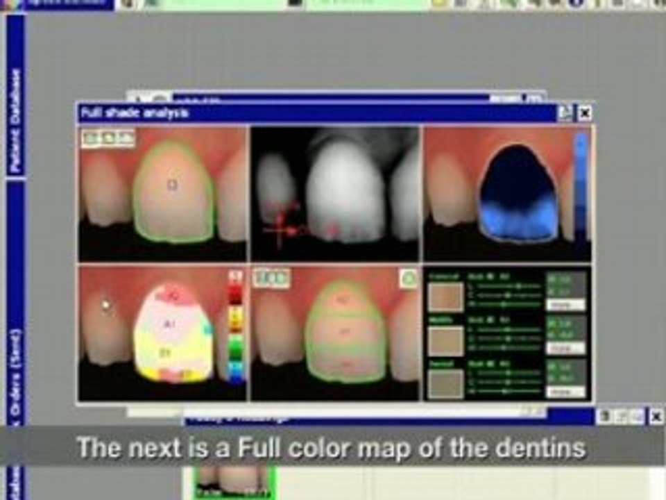 MHT SPECTROSHADE (Fast Color Analysis)