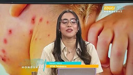 Vacuna contra el sarampión