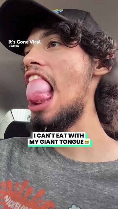 My tongue is the size of a baseball 😳