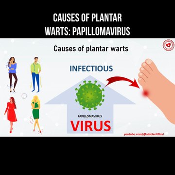 Causes of plantar warts: papillomavirus