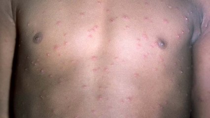 Chickenpox jab to be offered free on the NHS as back-to-school bugs spread