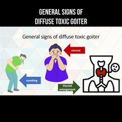 General signs of diffuse toxic goiter