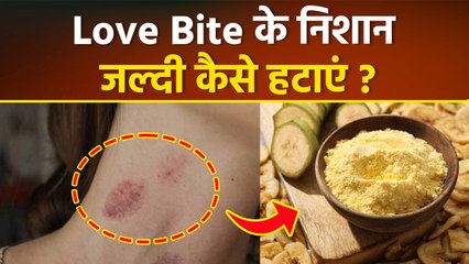 Love Bite Hide Tips: हिक्की को तुरंत कैसे हटाएं, लव बाइट गायब होने में कितने दिन लगते हैं..