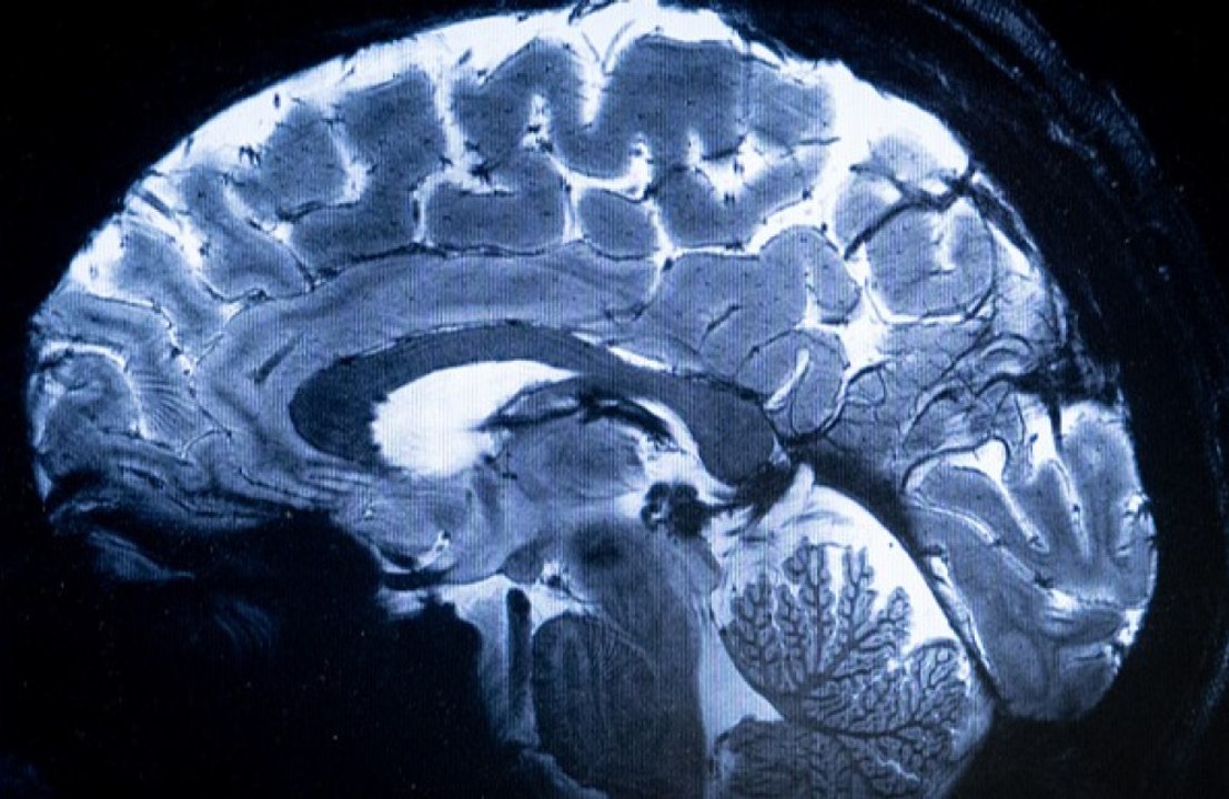 Simple test can detect Alzheimer's years in advance